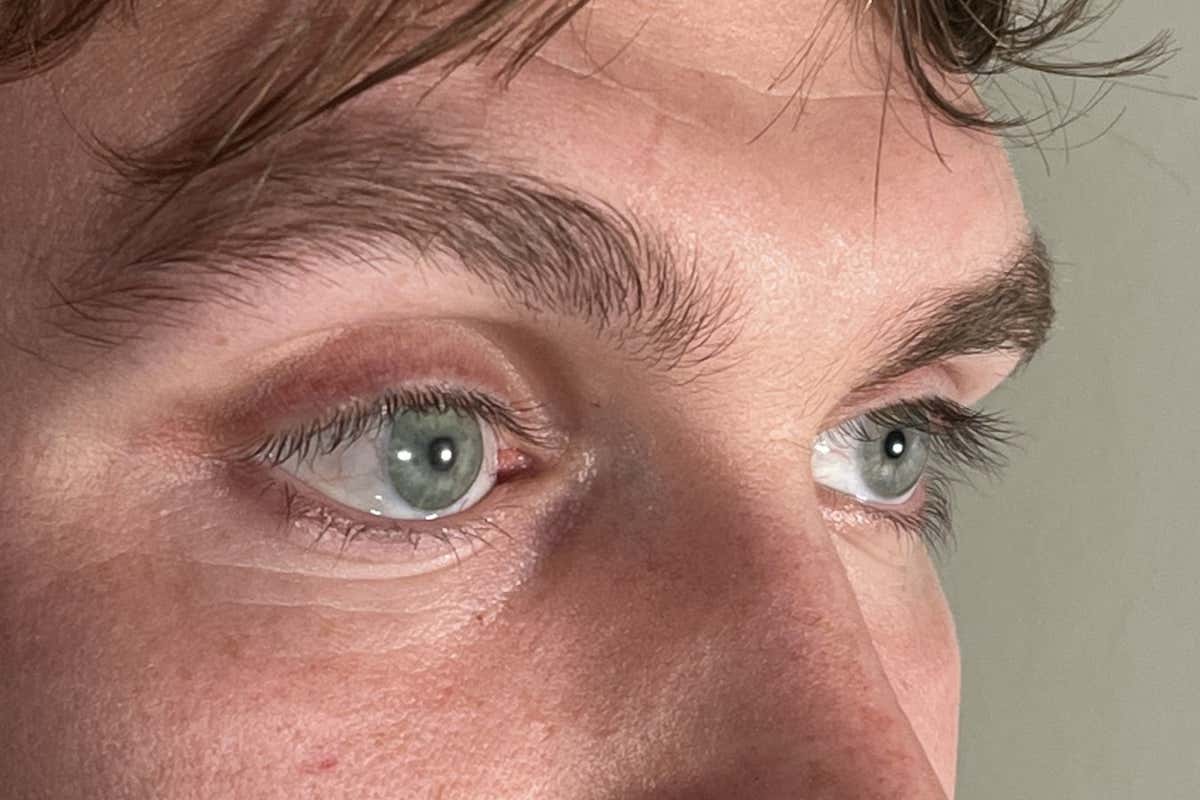 A man with a prosthetic right eye, which was not created via the AI approach
