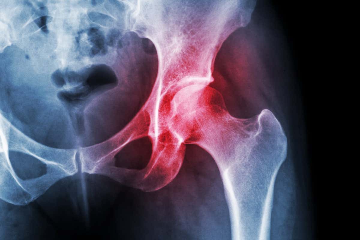 Arthritis at hip joint
