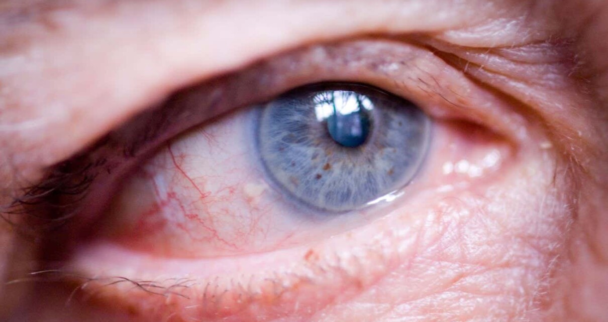 Chemical cocktail could restore sight by regenerating optic nerves