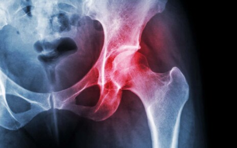Arthritis at hip joint
