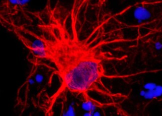 2JKFTNG Researchers study star-shaped brain cells: NIH-funded researchers have used 3D collections of brain tissue from human cells to study star-shaped astrocytes in the brain.