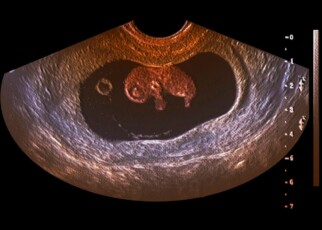 Coloured ultrasound scan of the abdomen of a pregnant female patient, showing a healthy nine week old foetus in the womb. At this age the foetus is about 5 cm long and weighs about 10 g.