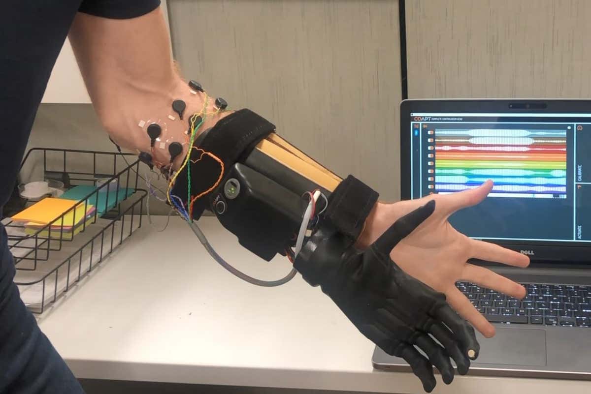 An advanced prosthetic limb called the i-LIMB Quantum Hand